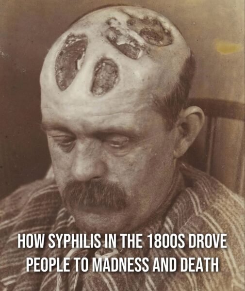 How Syphilis in the 1800s Drove People to Madness and Death