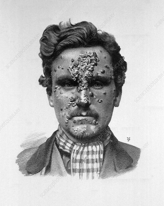 How Syphilis in the 1800s Drove People to Madness and Death