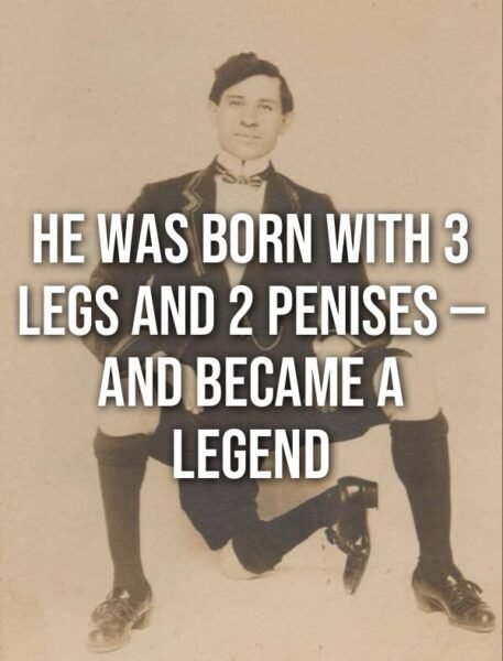Frank Lentini: The Three-Legged Man Who Lived a Full Life
